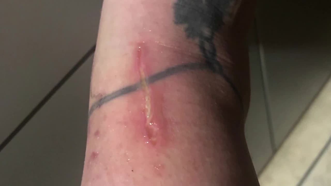 "Me escaló desde el tobillo hasta el muslo en menos de 24 horas": cuarta víctima de la bacteria "come carne" en Florida 