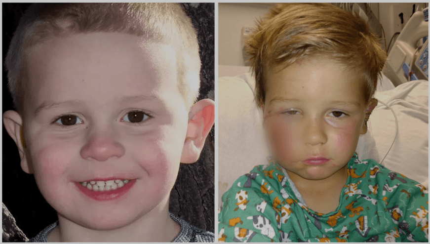 Niño de 5 años se recupera tras ataque de perro en Utah 