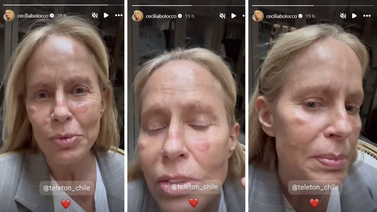 Así quedó la piel de Cecilia Bolocco.