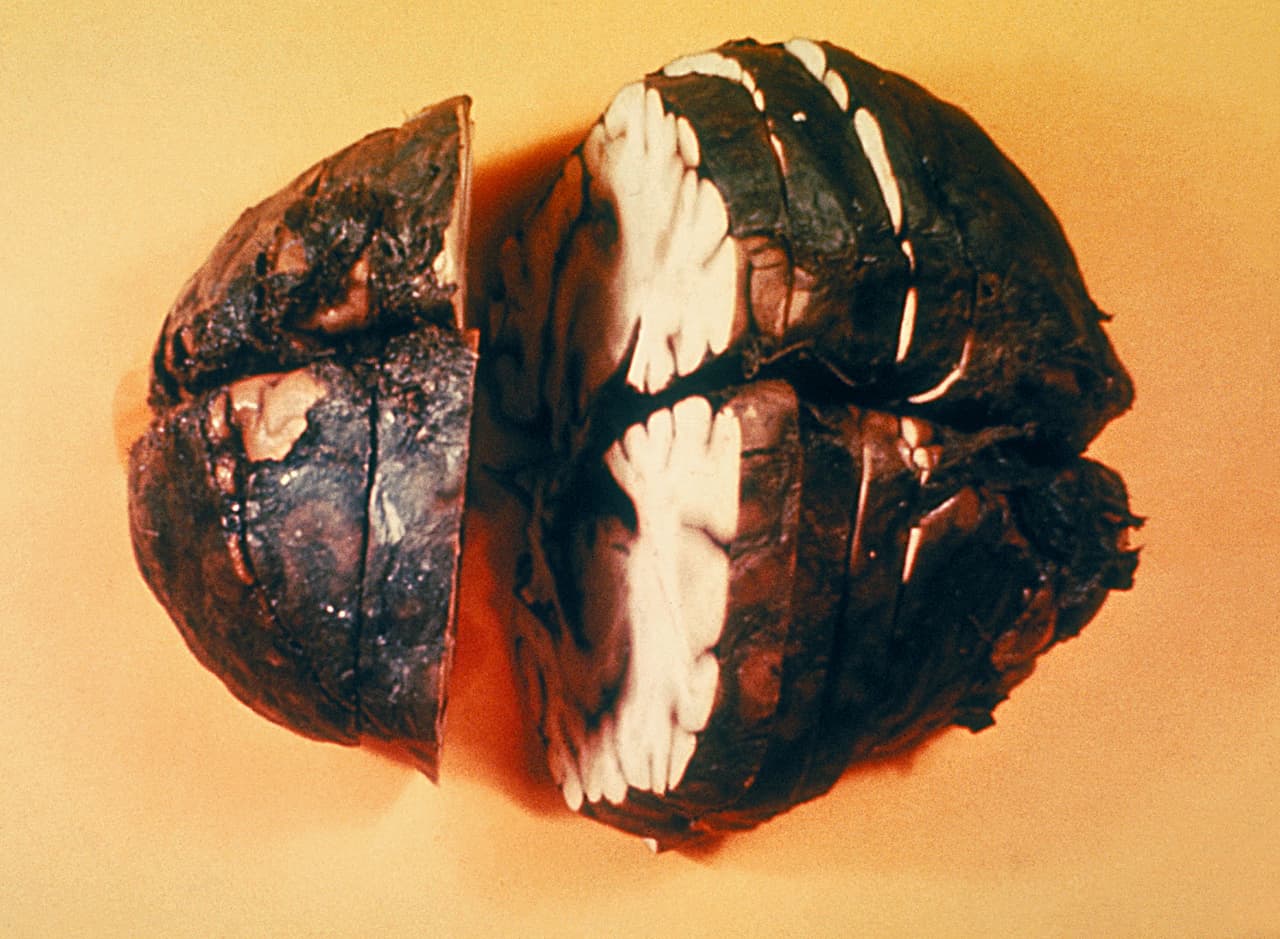 Muestra de un cerebro con meningitis hemorrágica.