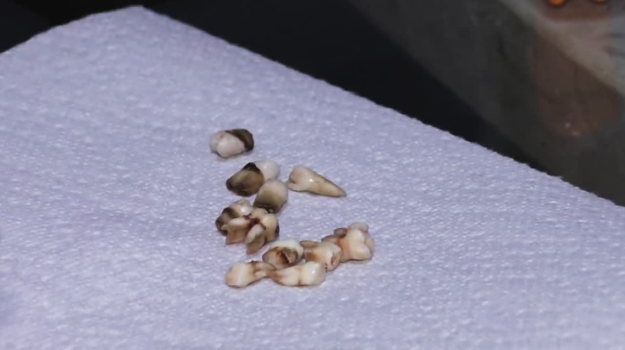 Madre denuncia extracción de 11 dientes a su hijo sin un consentimiento claro