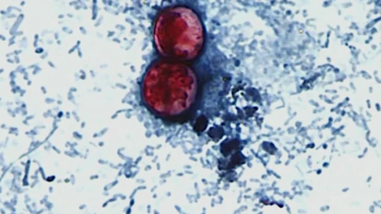 CDC confirman más de 11,500 casos de ciclosporiasis y 300 hospitalizaciones en el país