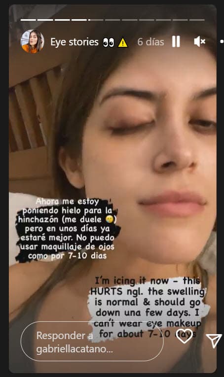 "Luego usan una herramienta debajo del párpado, dentro del ojo, que voltea el párpado de adentro hacia afuera. Hacen una pequeña incisión y comienzan a drenar el chalazión. Retiran la herramienta y colocan gasa sobre el ojo durante unos 15 minutos", continuó.
<br>