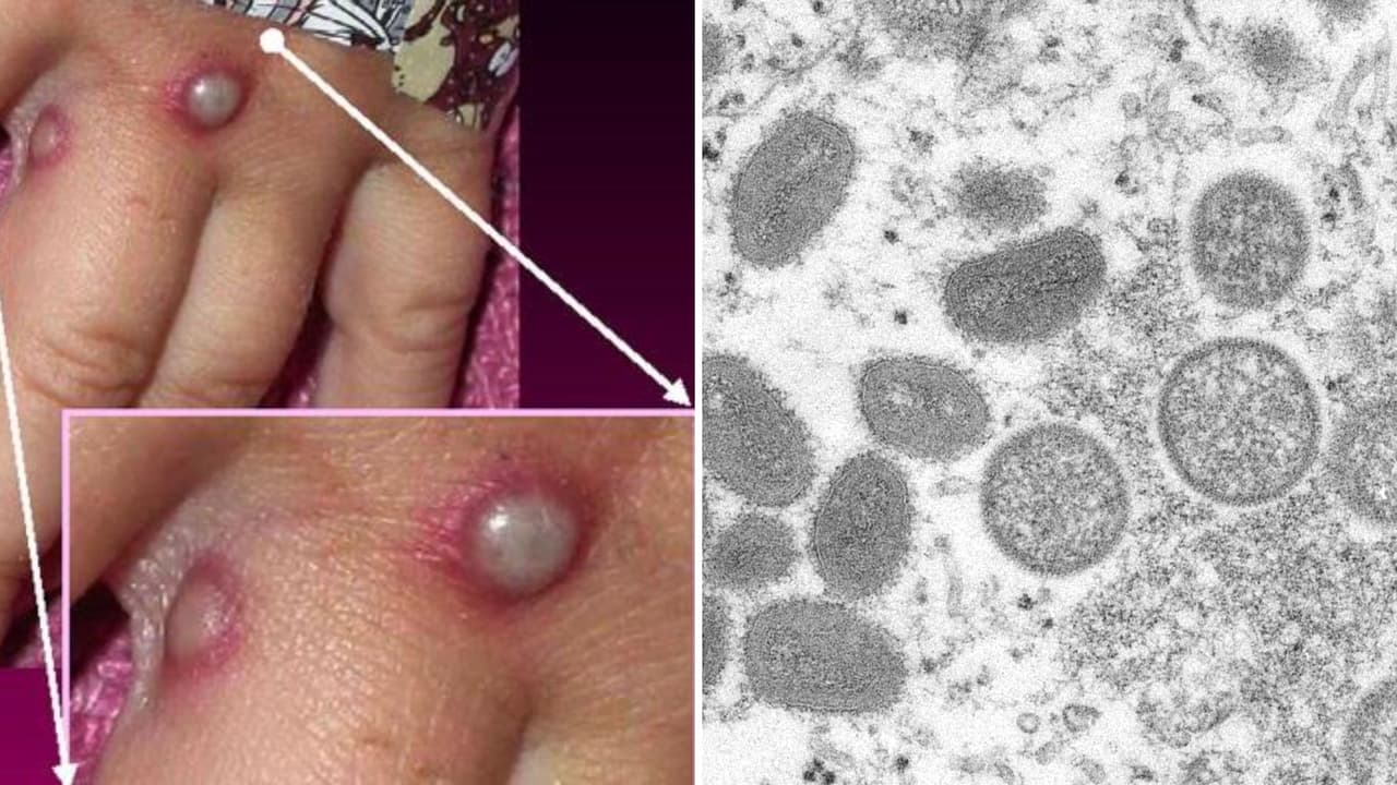 “Viajó desde México”: autoridades sobre paciente de Dallas con virus de la viruela del mono