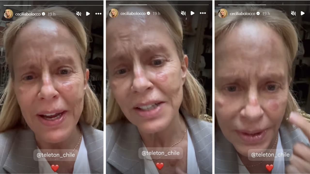 Cecilia Bolocco muestra las lesiones que sufre tras tratamiento.