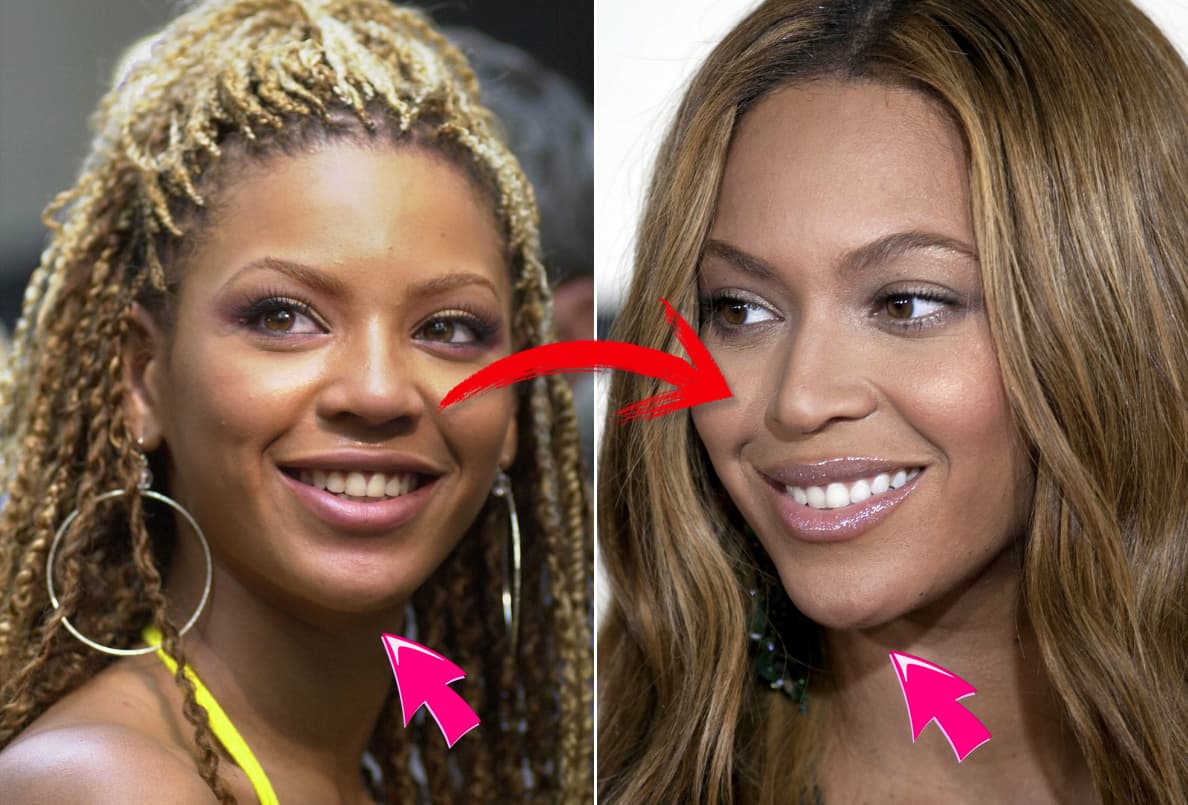 Entre otros detallitos, Beyoncé se acomodó el mentón, y afiló la nariz. ¡La diferencia es más que notoria!