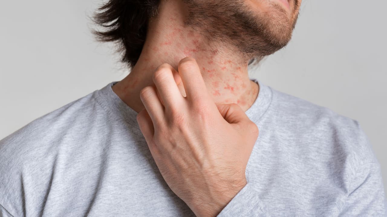 Los factores en la alimentación que causan reacciones como asma, urticaria o eccema