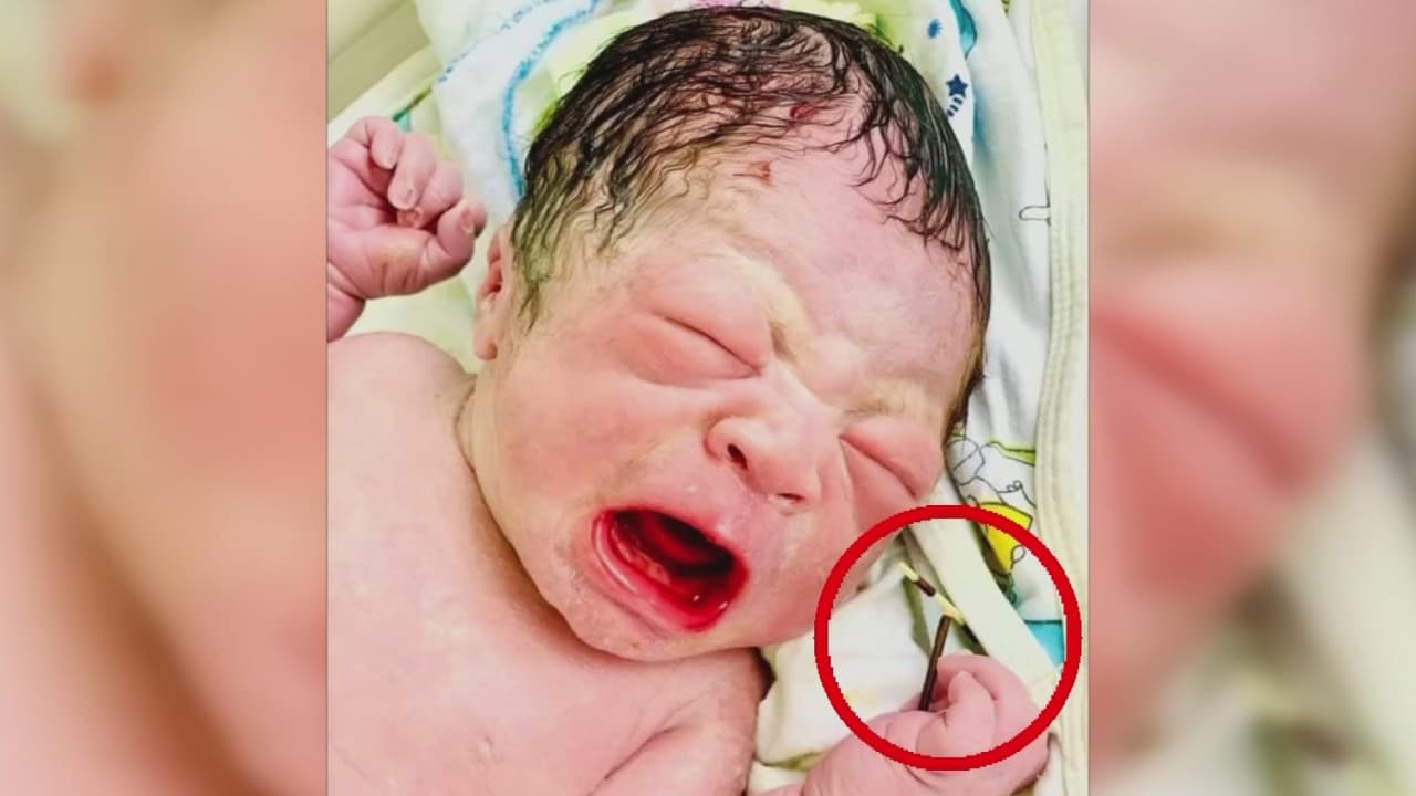 La insólita foto de un recién nacido con el dispositivo intrauterino que debió evitar su concepción 