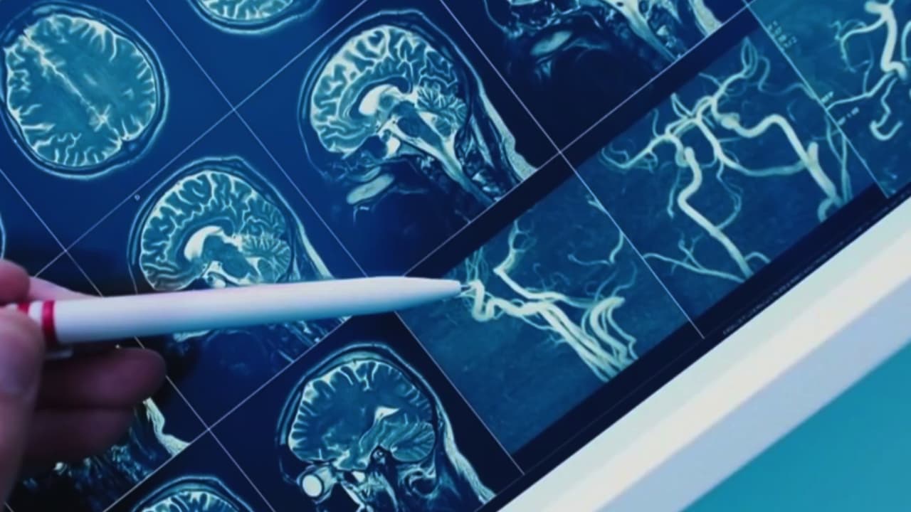 ¿El TDAH causa demencia en adultos? Un estudio revela importante información y esto explica un neuropsicólogo