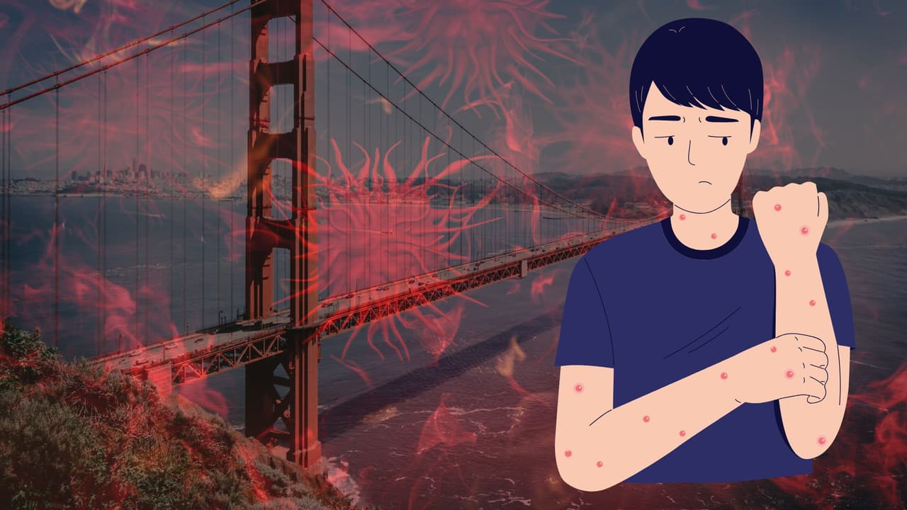 San Francisco se queda sin vacunas contra la viruela del mono y senador culpa al gobierno federal