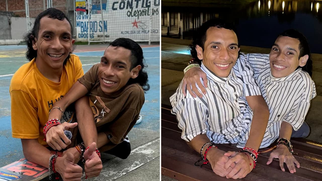 Siameses del Ecuador cumplieron su “ley de vida”: “Nacimos juntos y morimos juntos”
