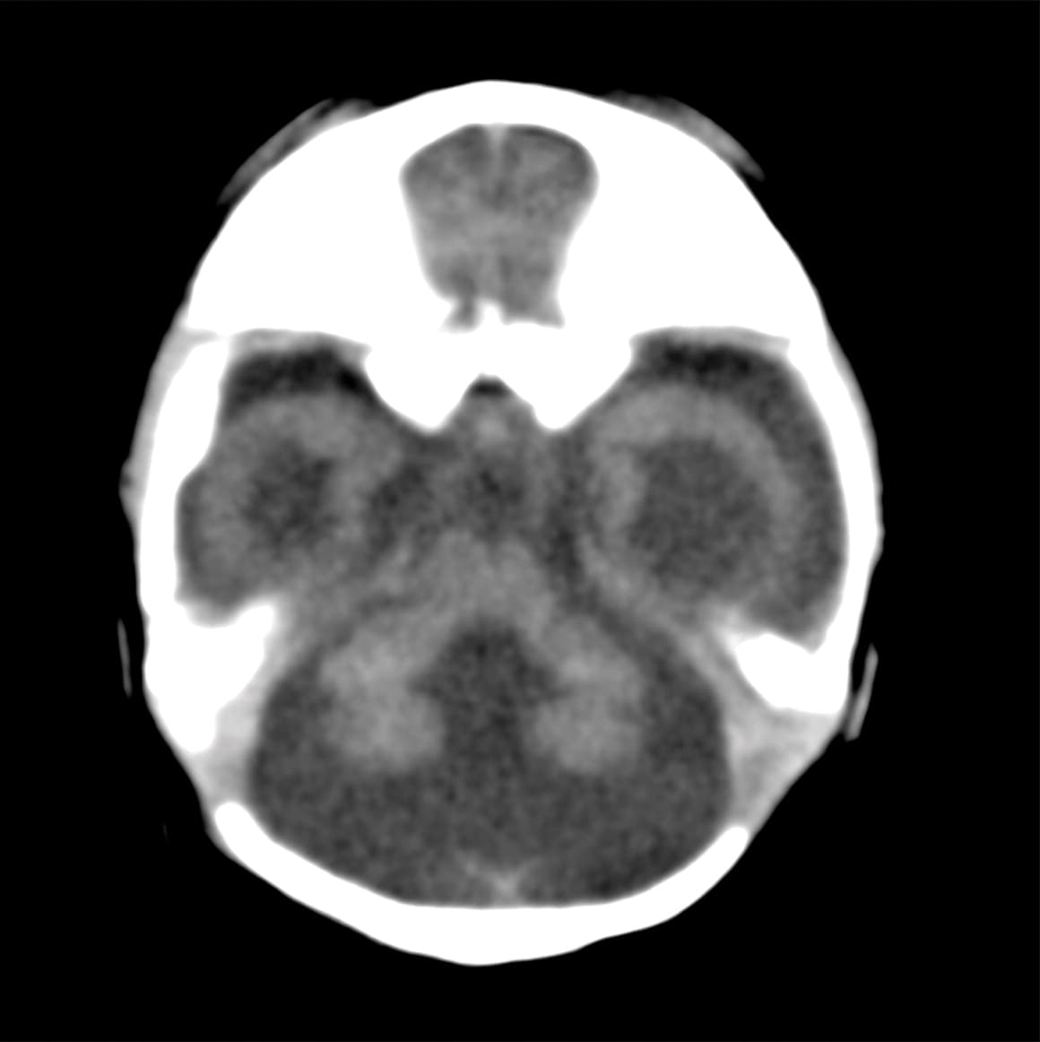 El feto falleció. Las imágenes computarizadas muestran que tenía calcificaciones en la materia blanca, el tálamo y los ganglios basales.