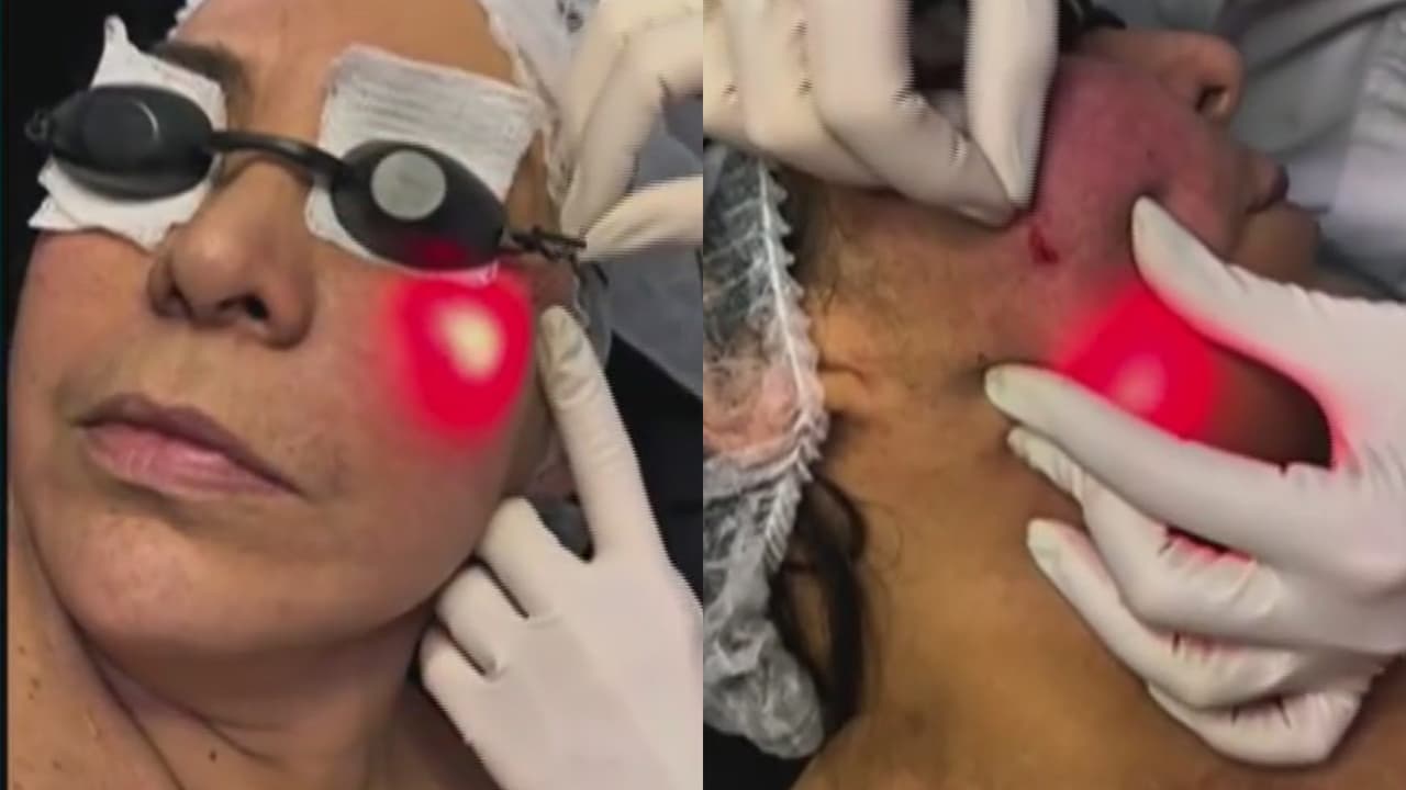 Endoláser, un tratamiento no quirúrgico que ayuda a la producción natural de colágeno