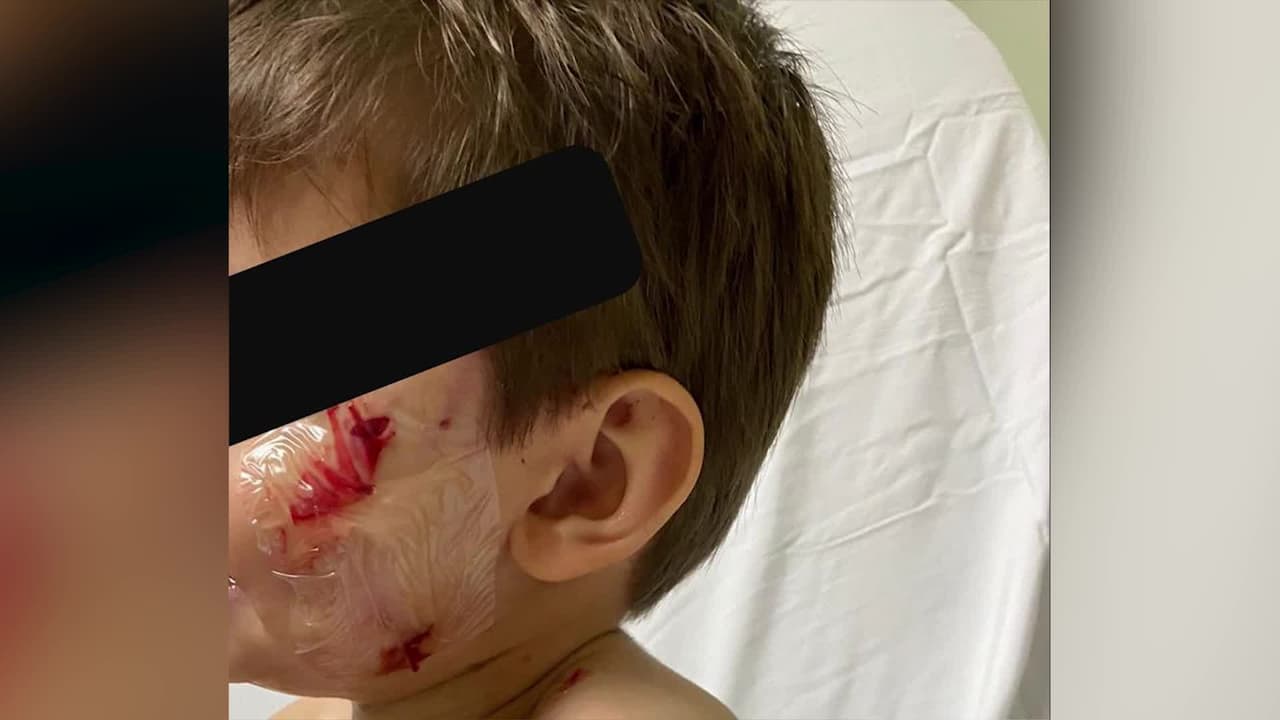 Así fue el ataque de un perro a un niño de dos años en un parque de Miami 