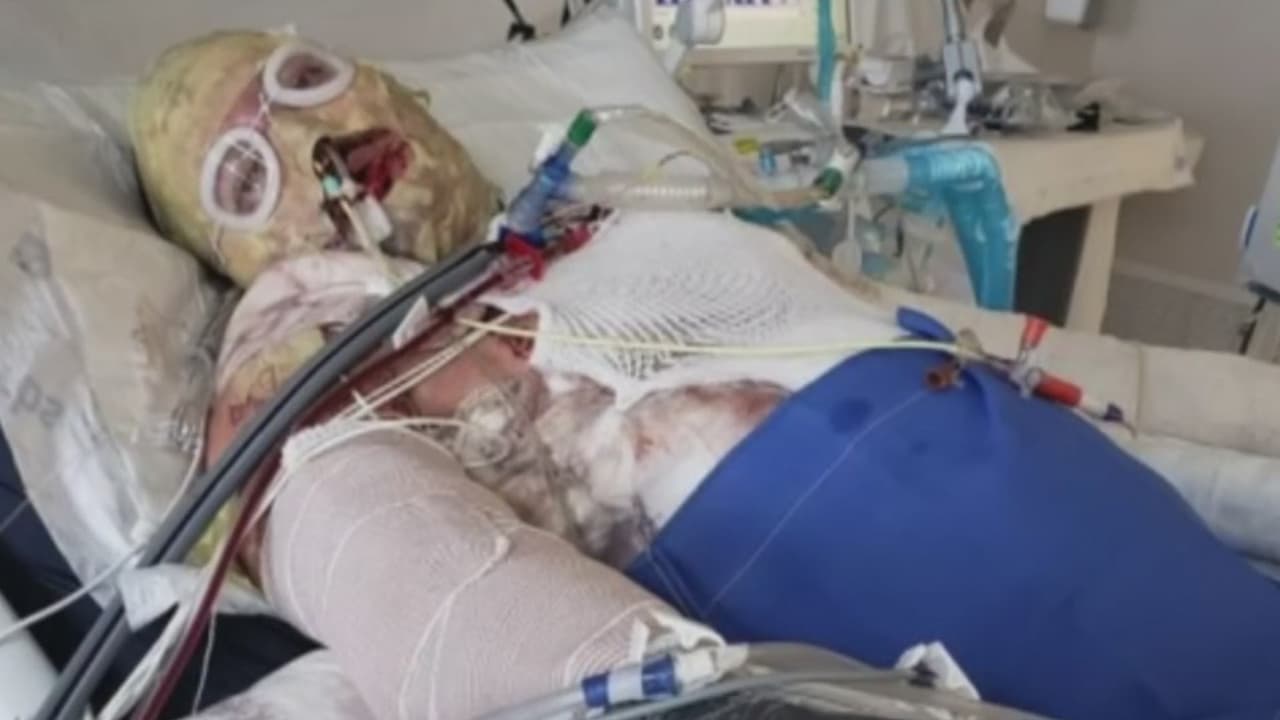 <b>Puertorriqueño sufrió quemaduras en el 70% de su cuerpo: ahora debe $ 1.7 millones por ir al hospital</b>
<br>
<br>En enero de 2019 el joven Alexis Hernández llegó a Guadalajara, México, a estudiar medicina, pero dos días después encendió el calentador de agua en su apartamento y se desató una explosión que lo dejó con quemaduras en el 70% de su cuerpo. Fue trasladado a EEUU para el tratamiento médico, pero ahora debe más de 1.7 millones de dólares por la atención que recibió.