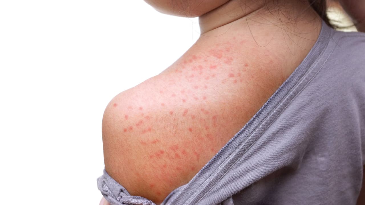 El sarampión es una enfermedad viral extremadamente contagiosa