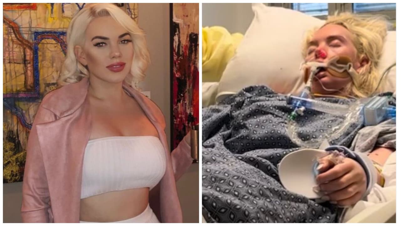 Modelo pierde una pierna tras infectarse con bacteria carnívora: historia conmueve a Internet