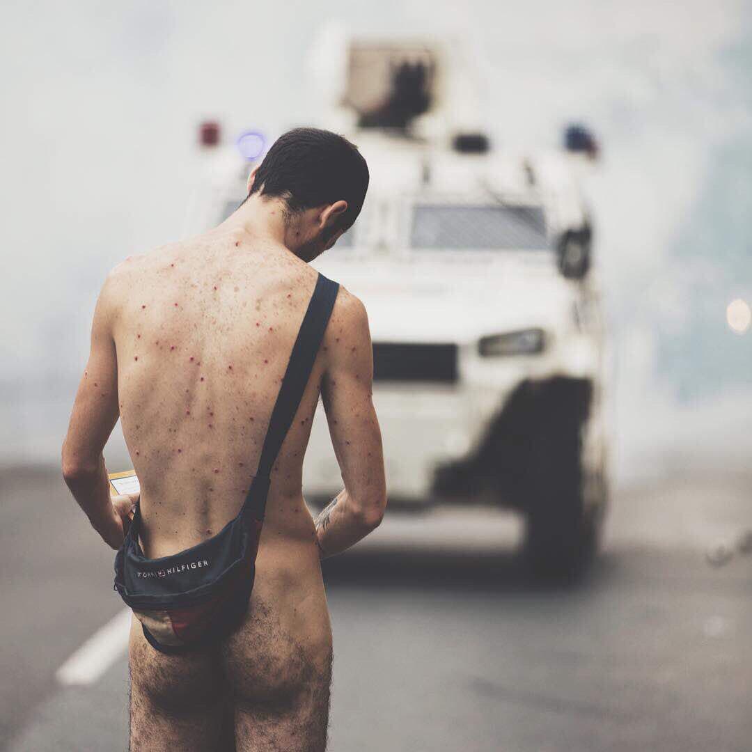 The back of the unnamed protestor was covered in birdshot wounds. (Twitter/Somos Venezuela)
