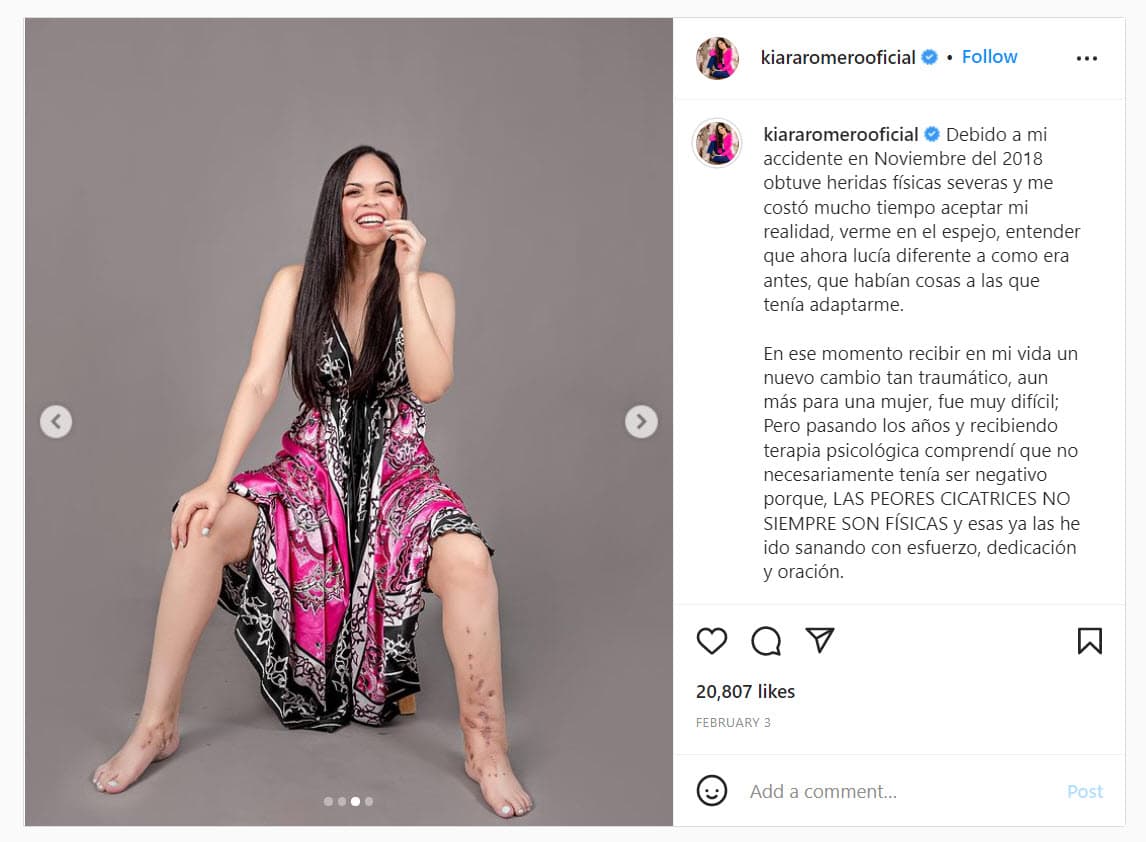 Kiara Romero mostró las cicatrices que le dejaron las ocho cirugías a las que fue sometida tras aventarse de un cuatro piso.