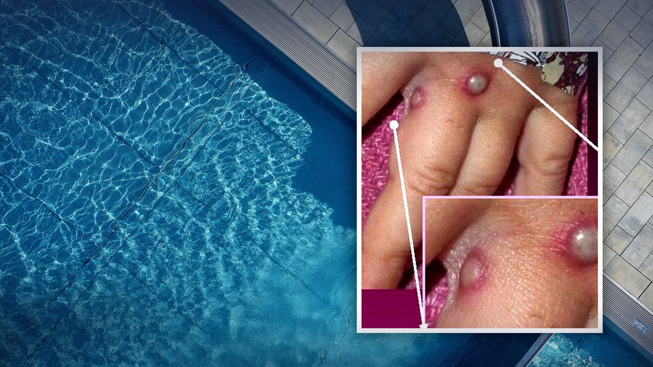 Texano con viruela del mono “se fugó" de un hospital en Puerto Vallarta  y voló a Dallas, dicen autoridades