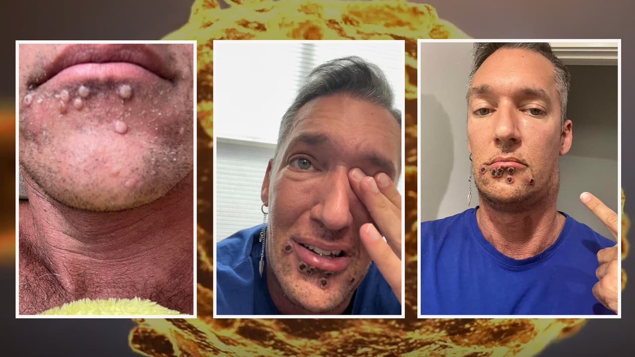 <h3 class="cms-H3-H3">¿Qué es la <a href="https://www.univision.com/local/los-angeles-kmex/medicos-advierten-sobre-virus-del-mono-o-monkeypox-estados-unidos" target="_blank">viruela del mono</a>?</h3>
<h3 class="cms-H3-H3"> </h3>
<br>
<br>“Es una enfermedad viral muy similar a lo que antes conocíamos como la viruela”, dijo el Dr. Goodman. Recalcó que puede transmitirse a través de gotitas respiratorias, contactos con fluidos corporales o contacto con un animal infectado.