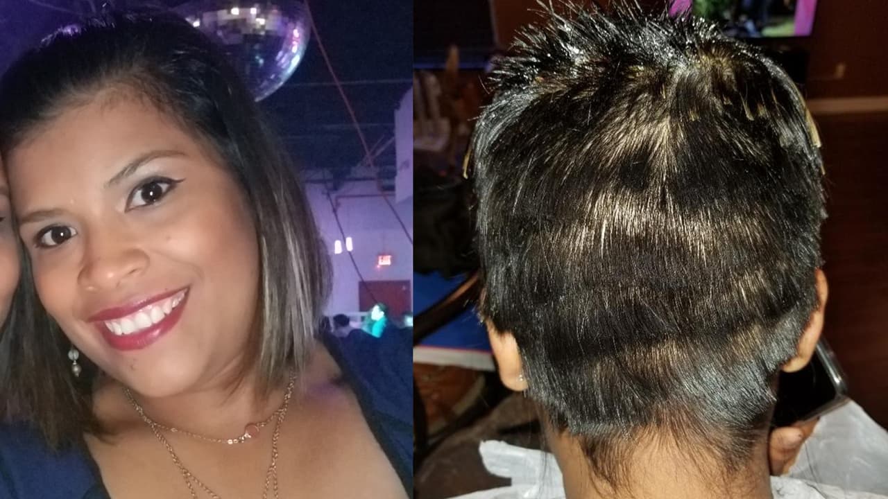 Estas fotos muestran a Idania Rivera antes del procedimiento y después de sufrir las quemaduras que le hicieron desprender el cuero cabelludo.