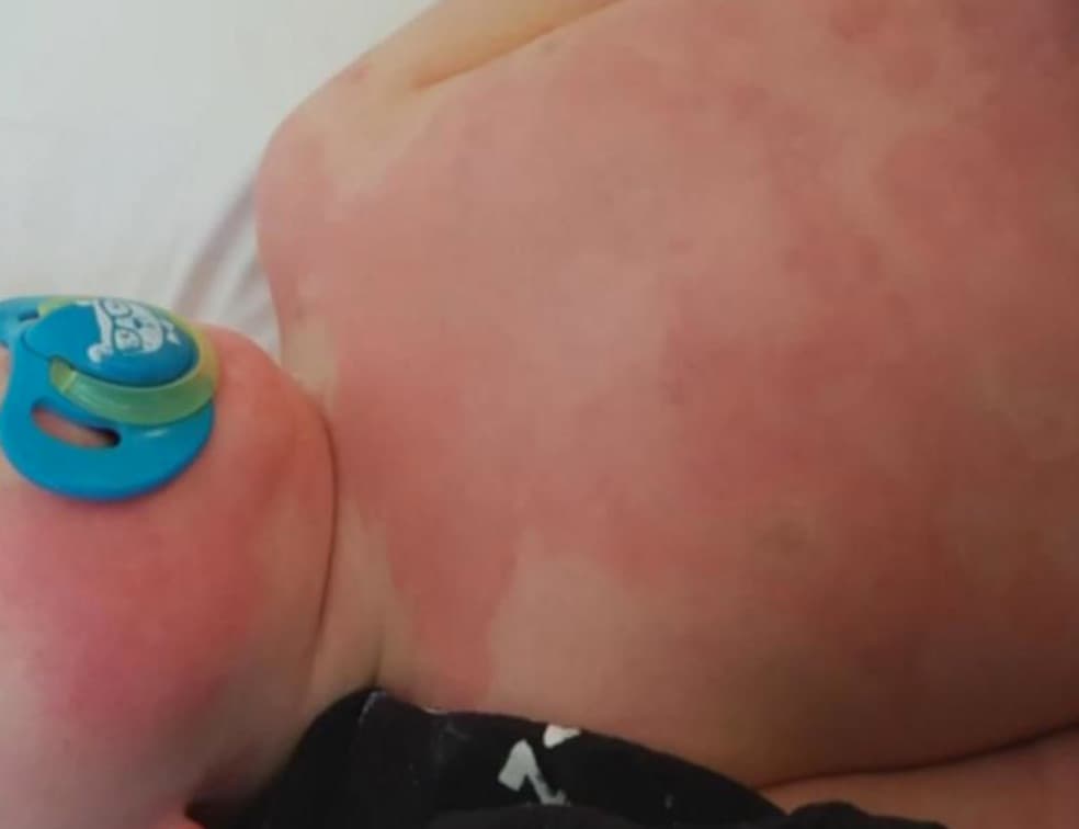 El Hospital de niños Holtz del Jackson y el Hospital de Niños Nicklaus confirmaron cada uno que tienen dos pacientes pediátricos ingresados con lo que llaman el Síndrome de Inflamación Multisistema.