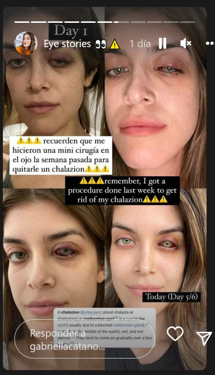 "
<b>Ya no está hinchado el ojo</b>, sigue morado, pero en un par de días se va a ir aclarando", contó.
<br>