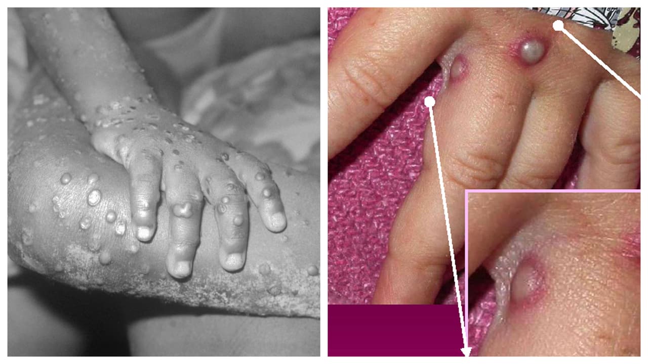 Confirman tercer caso de la viruela del mono en el condado Broward