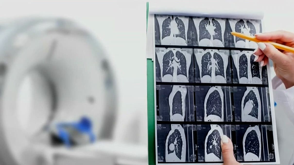 Registran casos de cáncer de pulmón en no fumadores, incluidos jóvenes ¿cuáles son las causas?