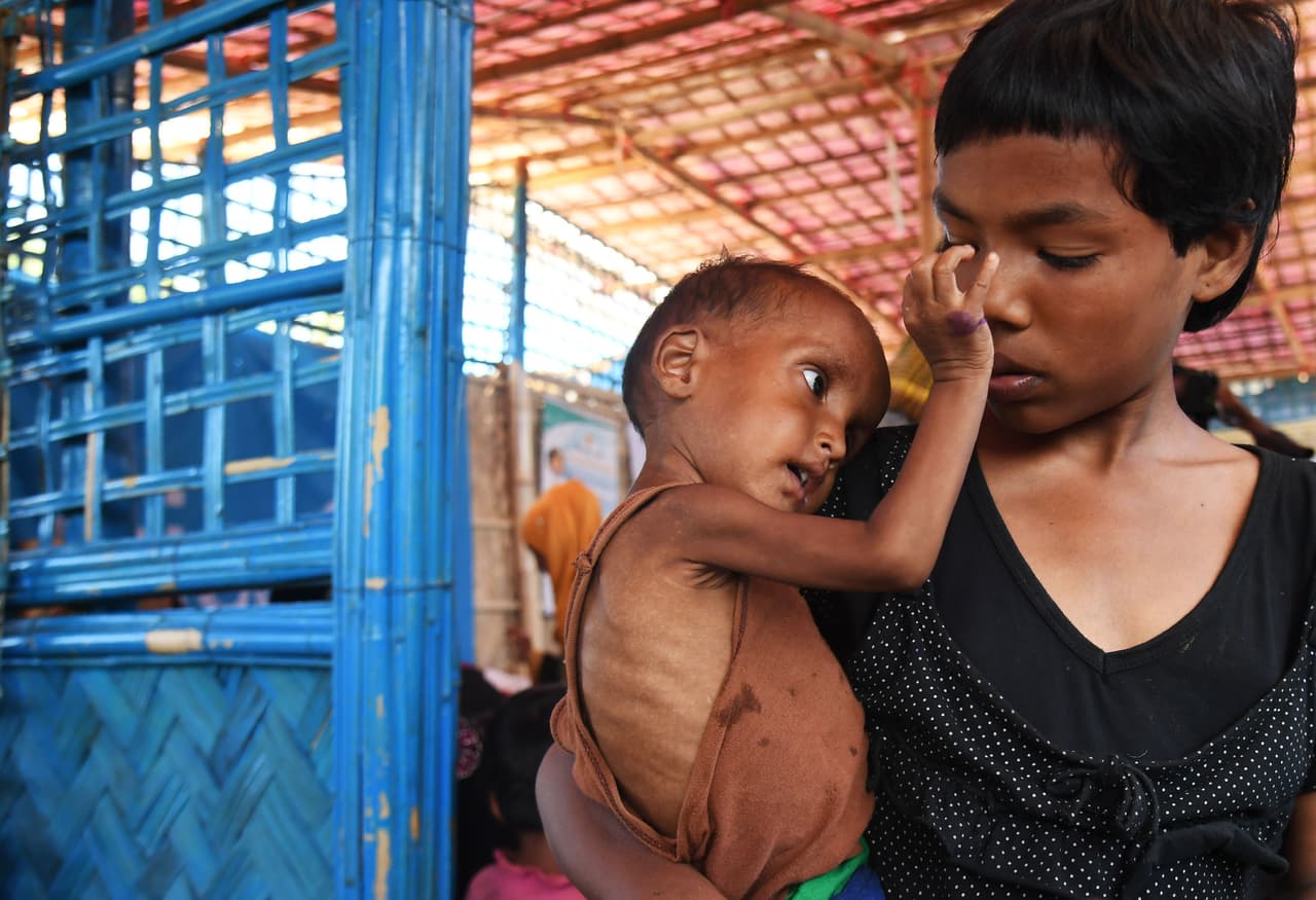 La pequeña Zahid Hasan, una refugiada musulmana rohingya de un año y medio de edad. Ella espera recibir tratamiento por desnutrición en Ukhia, Bangladesh, el 6 de noviembre de 2017.