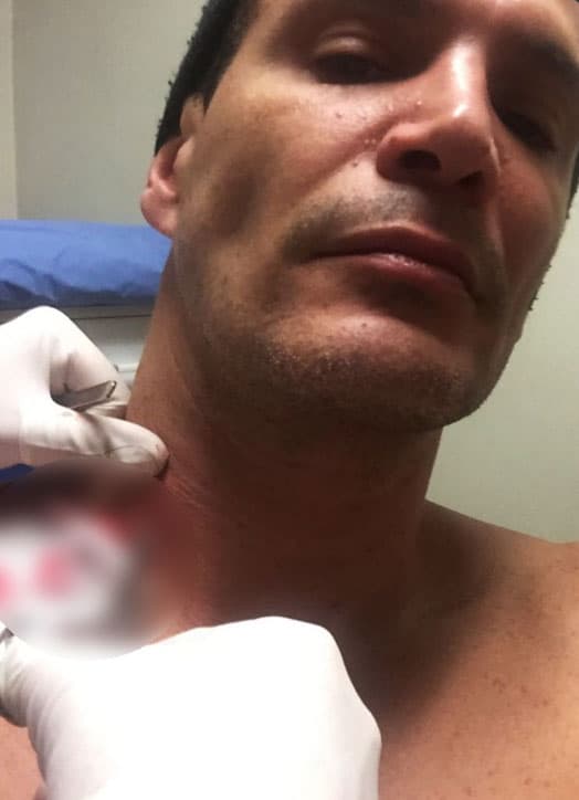 El actor recibió una herida en el cuello por un arma punzocortante que requirió una sutura de 4 puntadas.