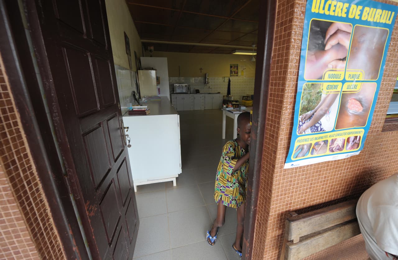 La úlcera de Buruli —una enfermedad infecciosa tropical, de la misma familia de bacterias de la lepra y la tuberculosis— y algunas formas de Leishmaniasis destruyen los tejidos blandos y pueden invadir los huesos.