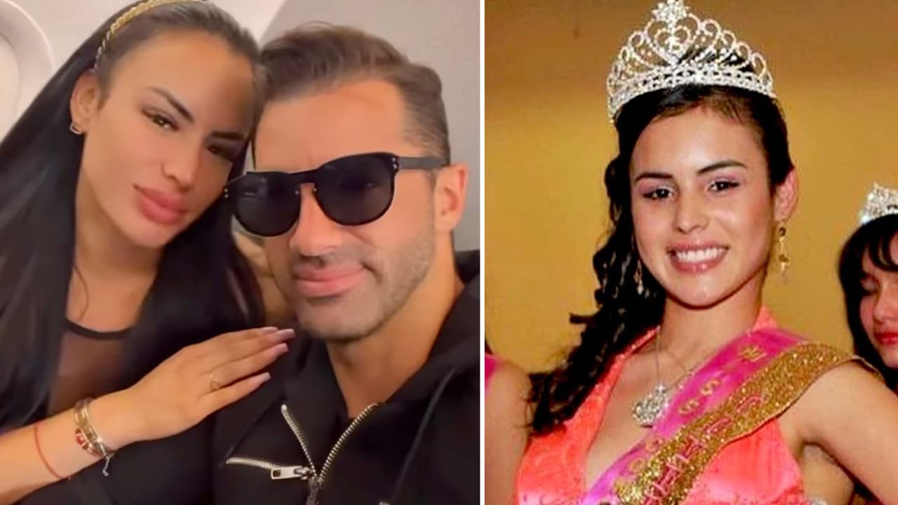 Novia de Toni Costa se quitó el relleno de los labios: necesitó un doloroso procedimiento para hacerlo
