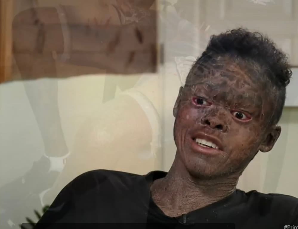 “La resequedad de la piel me corta y sangro mucho”, dice Estévez, quien además dice estar deprimido desde hace tiempo cuando incluso tuvo que dejar de estudiar por el miedo que provocaba en los demás niños de la escuela. 
<br>