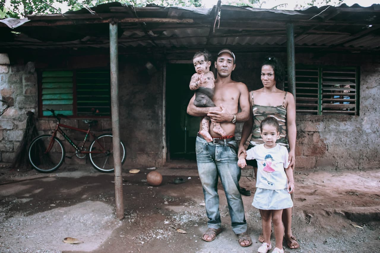 Yandier –dos años de edad, aquí junto a su familia– padecía un tumor en la piel que puede transformarse en cáncer y que además le provocaba ataques epilépticos. La enfermedad deriva de varios factores, pero uno de los agravantes pueden ser las radiaciones químicas. El caso de Yandier expuso las condiciones de salud de los pobladores de Moa, las consecuencias ambientales de un proceso minero dañino y poco controlado.