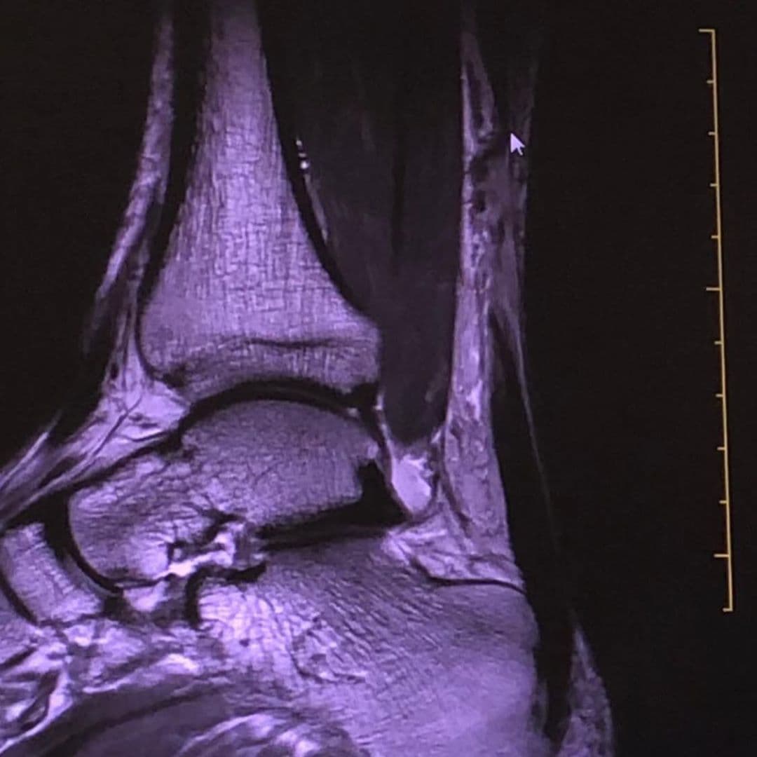 Durante el programa también compartió las imágenes del procedimiento, alegando cómicamente que "la gente siempre ha querido conocerme por adentro, entonces por ahí pueden verme por un hoyito".