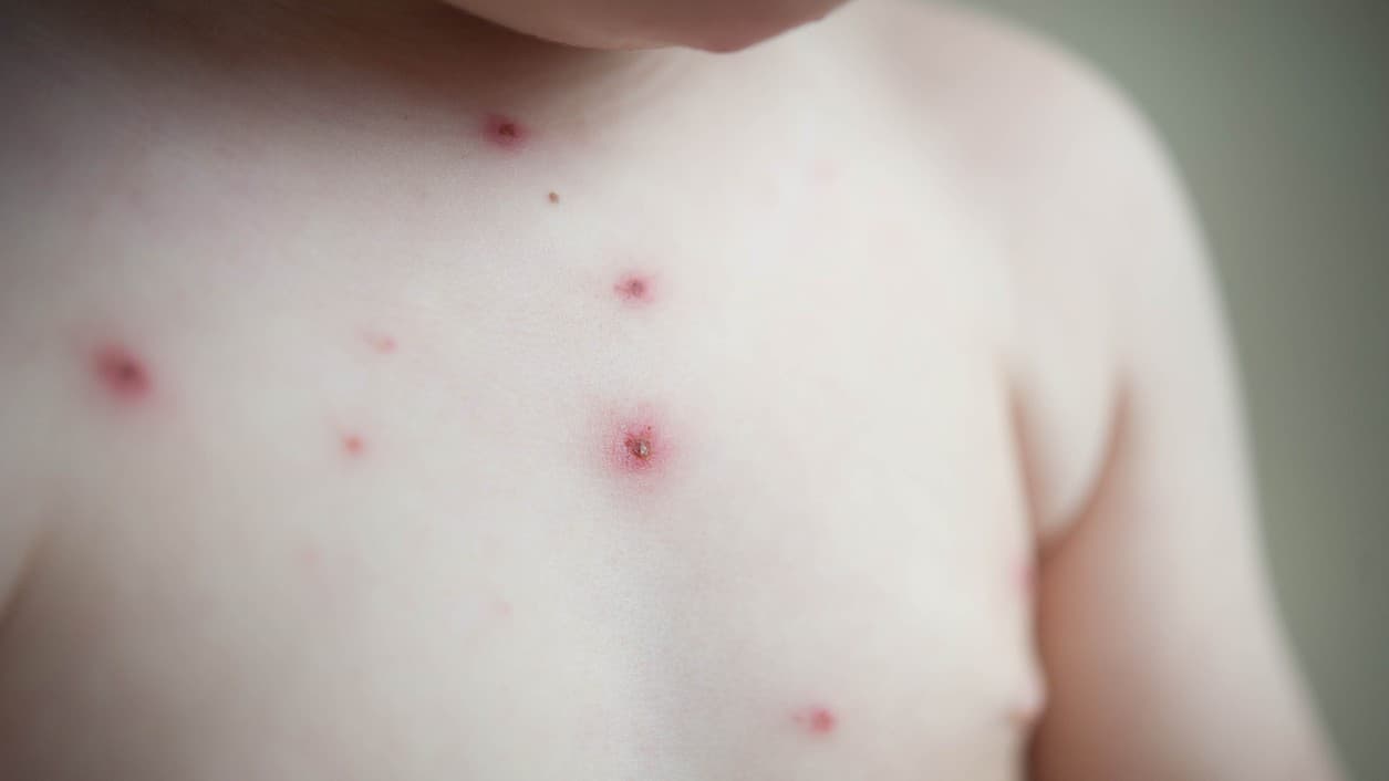 Varíola dos macacos é confirmada em 2 bebês no Brasil: um de 10 meses e outro de 60 dias
