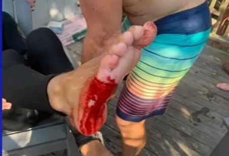 El 20 de julio un 
<b><a href="https://www.univision.com/local/nueva-york-wxtv/tiburon-muerde-joven-fire-island" target="_blank">joven de 16 años fue mordido por un tiburón en Fire Island</a>, </b> lo que le causó heridas importantes en su pie derecho.