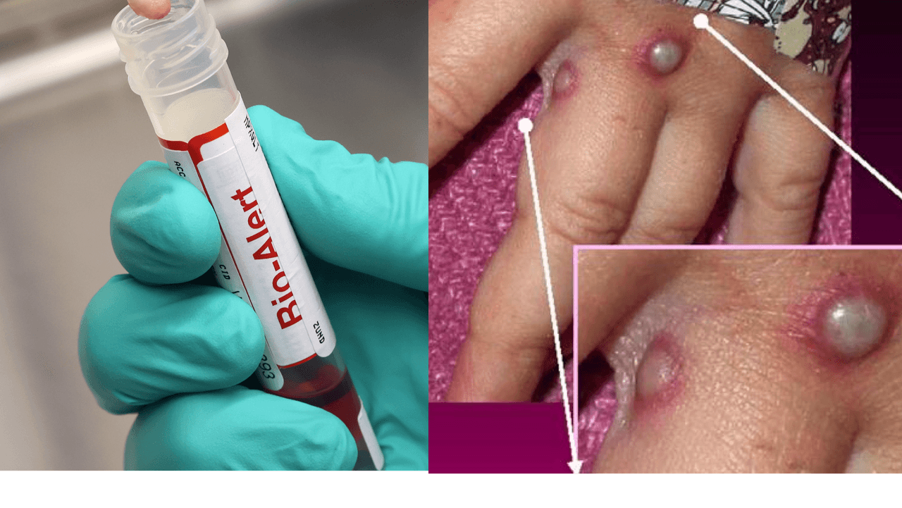 Detectan dos casos de viruela del mono en niños; uno es de California