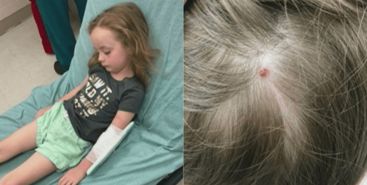 Otra consecuencia que puede conllevar la mordedura de una garrapata es una
<b> parálisis temporal</b> que, se cree, es ocasionada por un veneno presente en la saliva de algunas garrapatas. Habitualmente se cura al remover la garrapata de la piel. Exactamente esto fue lo que le ocurrió a 
<a href="https://www.univision.com/noticias/salud/una-nina-de-5-anos-sufrio-una-misteriosa-paralisis-su-madre-le-reviso-el-cuero-cabelludo-y-descubrio-de-que-se-trataba">una niña en Mississippi</a>.
<br>