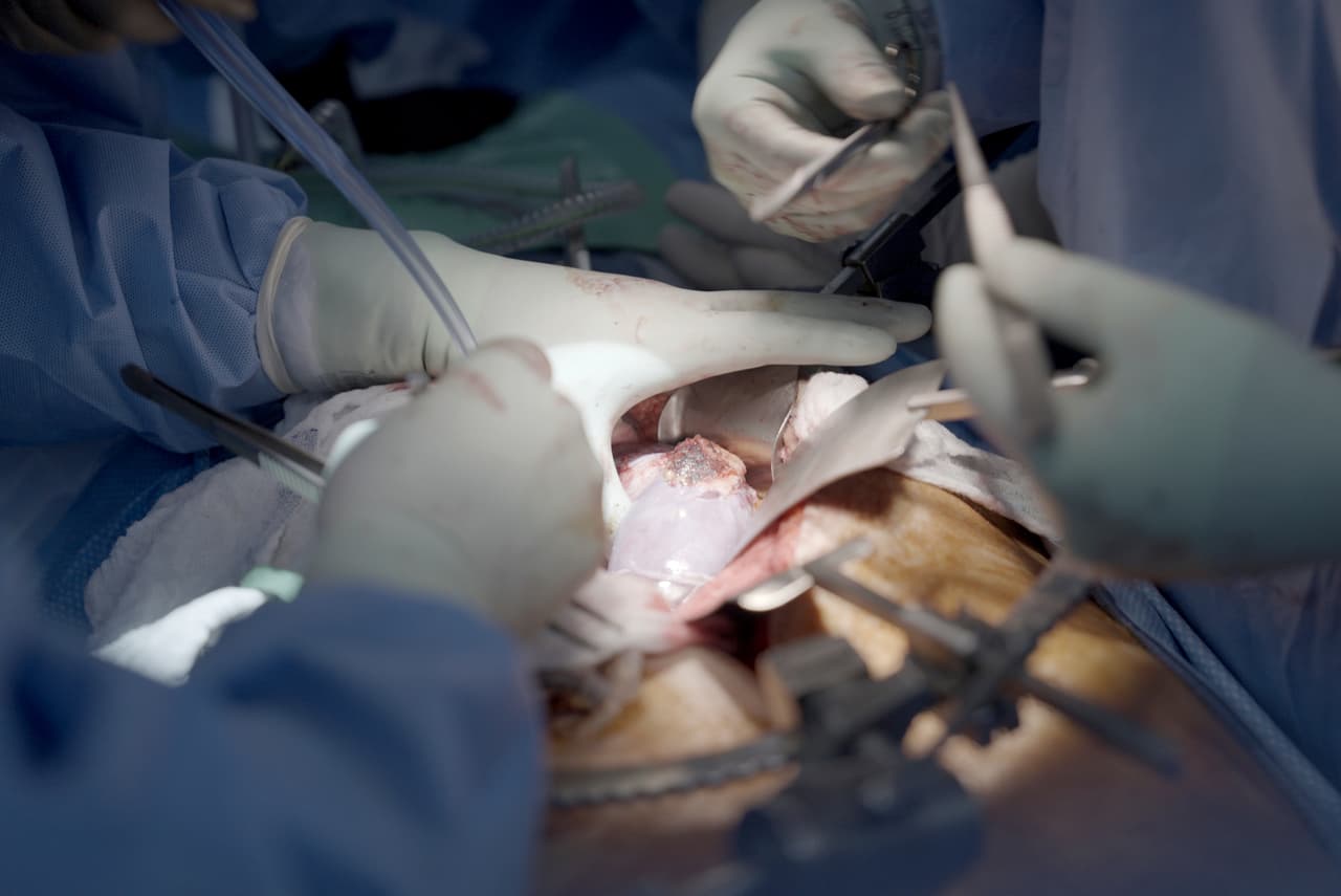 Sale del hospital la primera persona en recibir un trasplante de riñón de un cerdo 