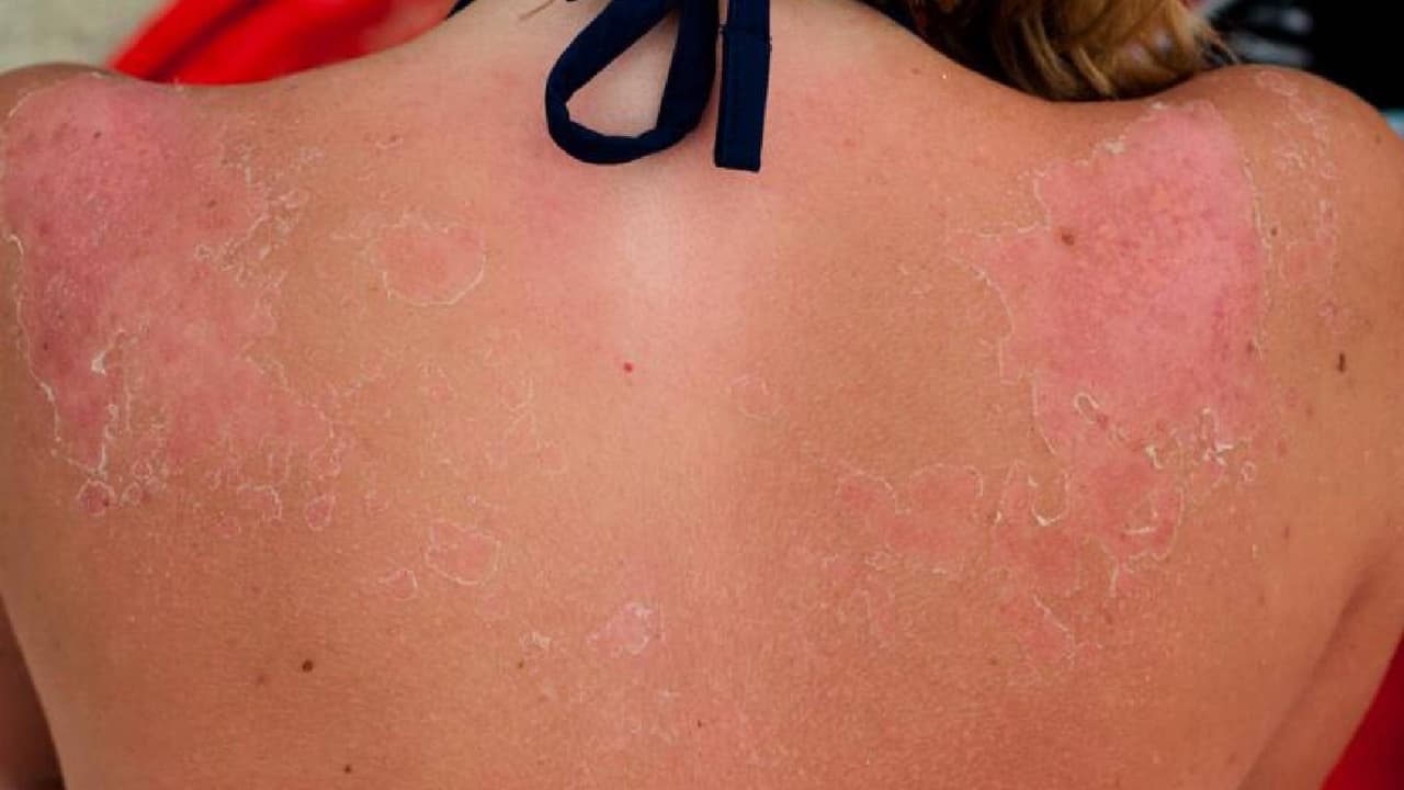 Si salen ampollas en la piel, deja que se curen. Las ampollas significan que tiene una quemadura solar de segundo grado. 
<b>No debes reventar las ampollas</b>, ya que se forman para ayudar a que su piel sane y protegerte de infecciones.