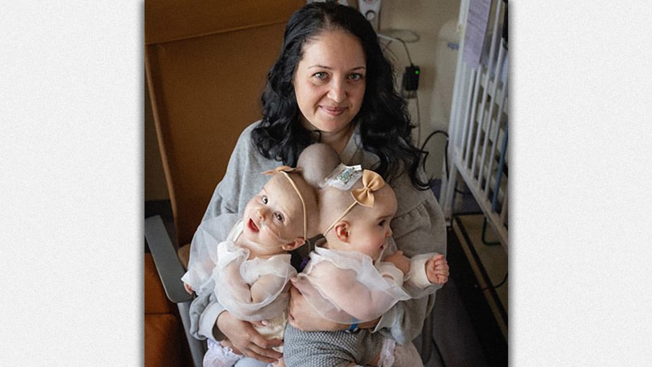 Liliya Miroshnik y sus hijas Abigail and Micaela de 9 meses de edad. Las niñas fueron separadas de manera exitosa en una cirugía que duró 24 horas.