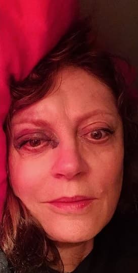 "Un 
<b>pequeño resbalón</b> = contusión cerebral, fractura de nariz, rodilla golpeada", escribió Sarandon junto 
<b><a href="https://www.instagram.com/p/B5LKtHkhQbT/" target="_blank">a la imagen</a></b> en donde se pueden observar las consecuencias del accidente.