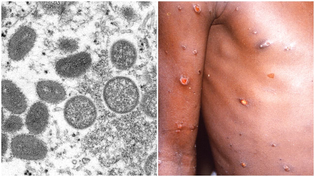 Un paciente de Nueva York dio positivo por el virus relacionado con la viruela del mono