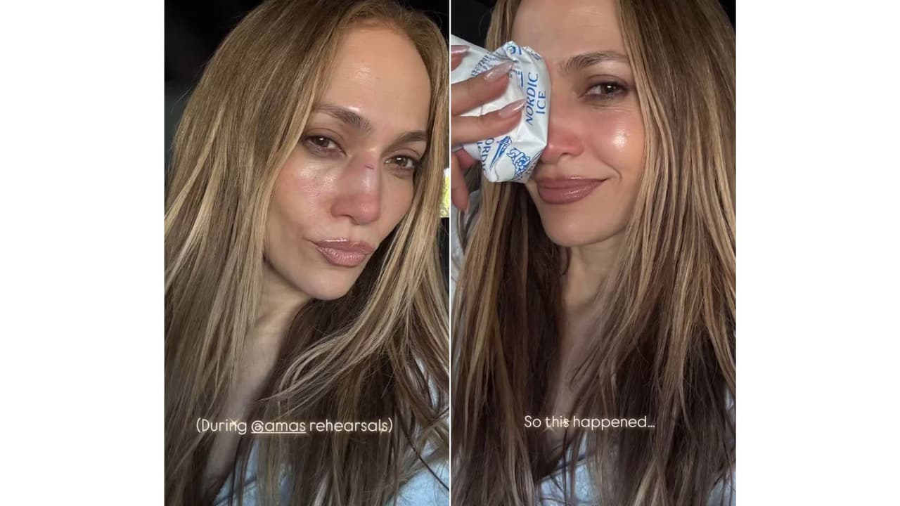 Así apareció Jennifer López con el rostro lesionado.