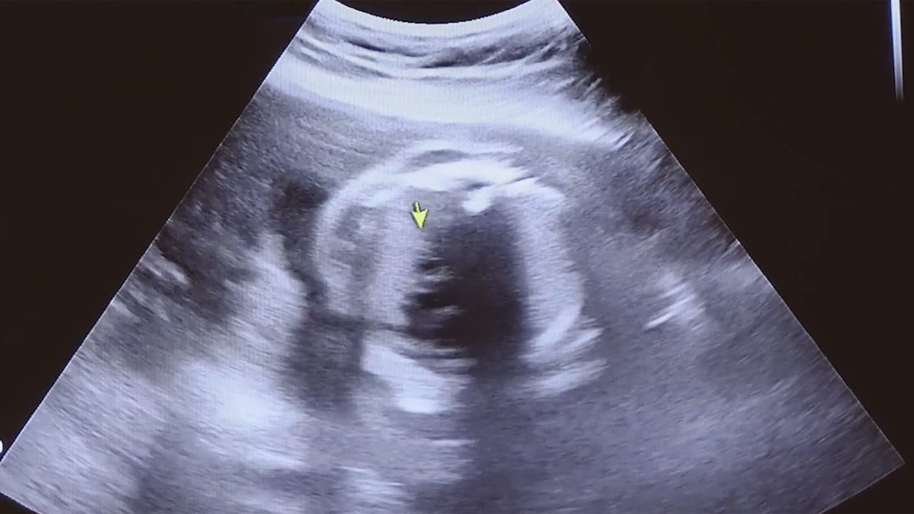 <b><h3 class="cms-H3-H3">Mito: "Las embarazadas deben usar un listón rojo en su barriga o un segurito de metal para proteger al bebé"</h3></b>
<br>
<br>
<b>”No tienen ningún sentido”, dice el ginecólogo Gonzalo Venegas,</b> “No protege, pero sí, la gente tiene creencias". 
<br>
<br>Entonces nosotros tratamos de educar a las personas para decirles que esto no afectará, pero es cómo usted se sienta”.
<br>
<br>Lo que sí puede provocar un parto prematuro son situaciones de estrés en las embarazadas, aclara el médico. 
<br>
<br>“El eclipse causa un cierto temor o miedo y la persona, cuando tiene miedo, desencadena el estrés”, dice, “El 
<b>estrés sí puede desencadenar un trabajo de parto</b>”.