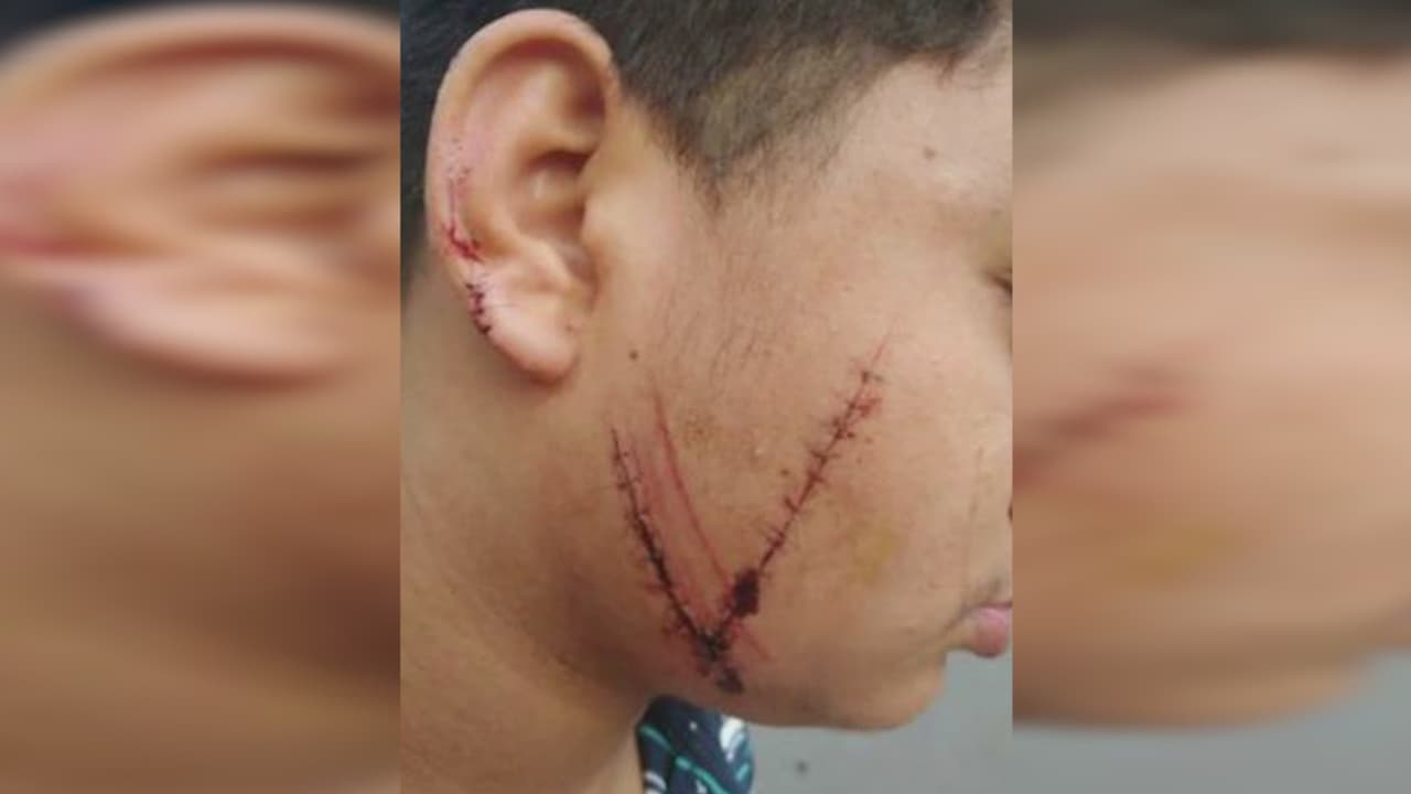 Cortan la cara a un niño hispano con una navaja de afeitar tras una pelea en la escuela 