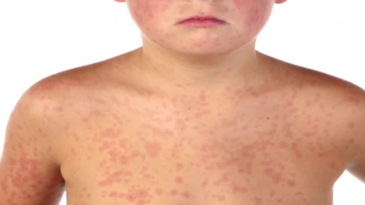 Los casos de sarampión en Nueva York ya casi suman 400, incluyendo dos mujeres embarazadas 